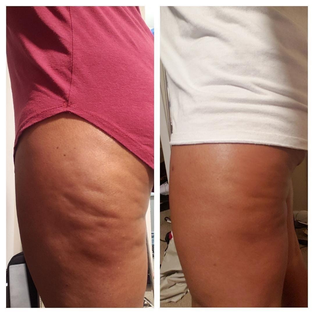 Anti Cellulite Massage Oil